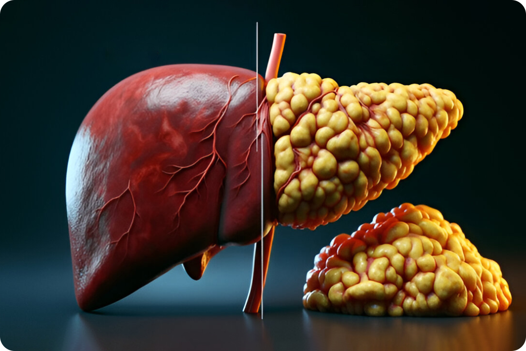 Liver Cirrhosis